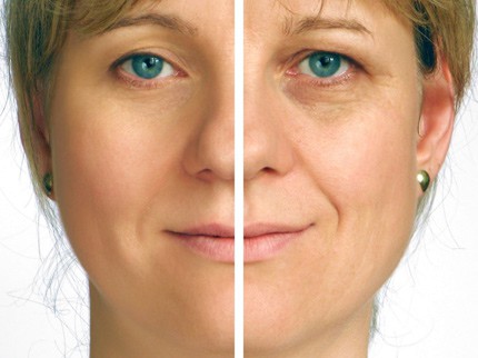 laser envelhecimento pele