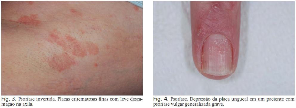 psoriase dermatite
