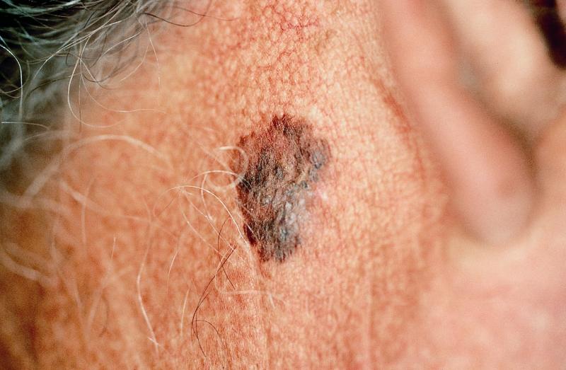 cancer de pele melanoma