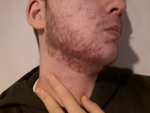 espinhas barba homem