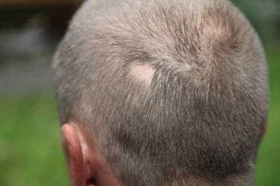 alopecia-areata-e-seu-cabelo