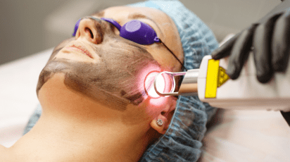 Melhor laser para manchas - veja qual é e principais características