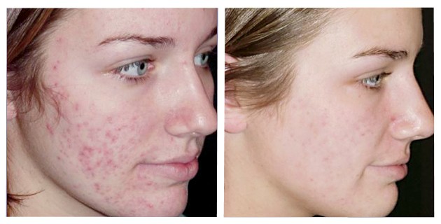 tipos de acne