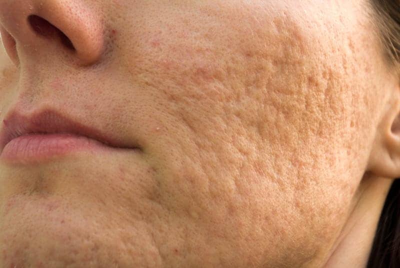 tratamento de cicatriz de acne