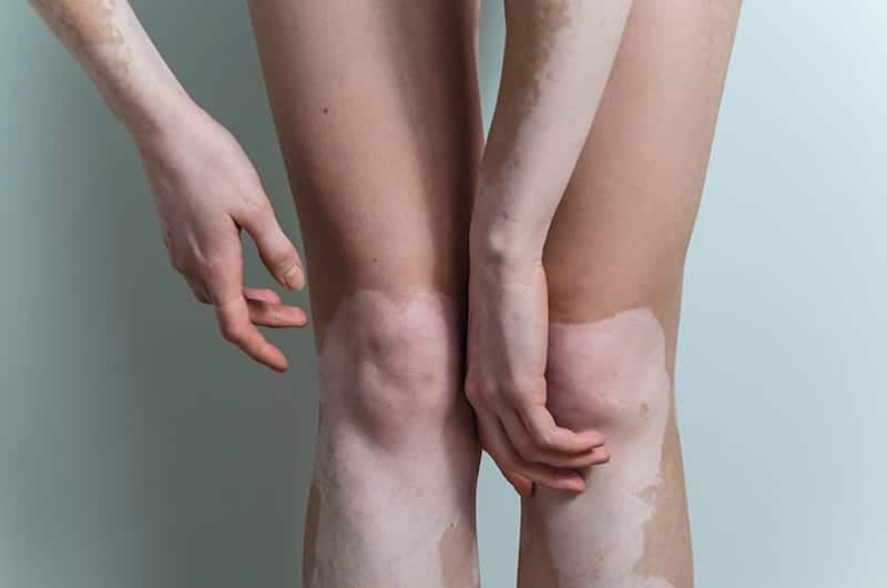 tratamento-de-vitiligo