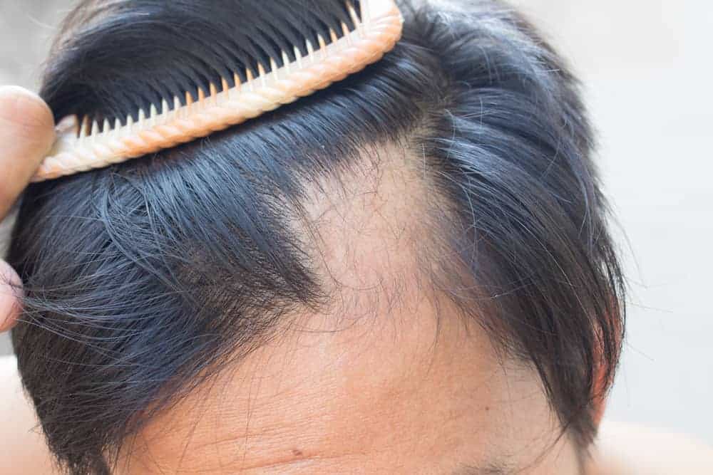 queda-de-cabelo-alopecia-areata