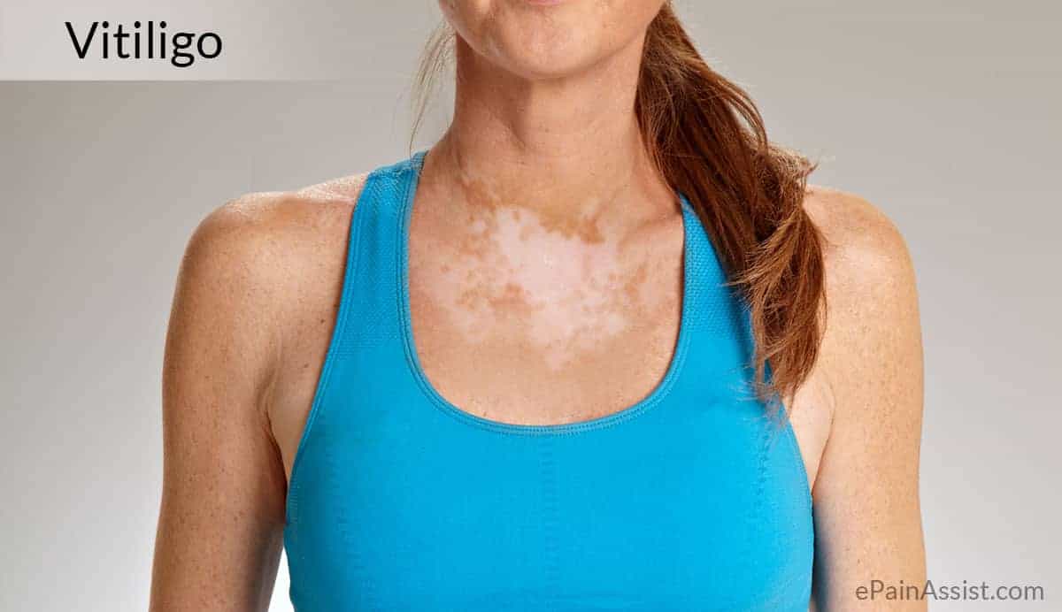 Vitiligo: Aprenda mais - Instituto Dra. Juliana Toma