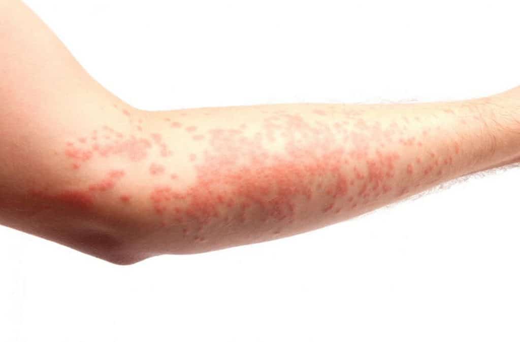 urticaria dermatologia