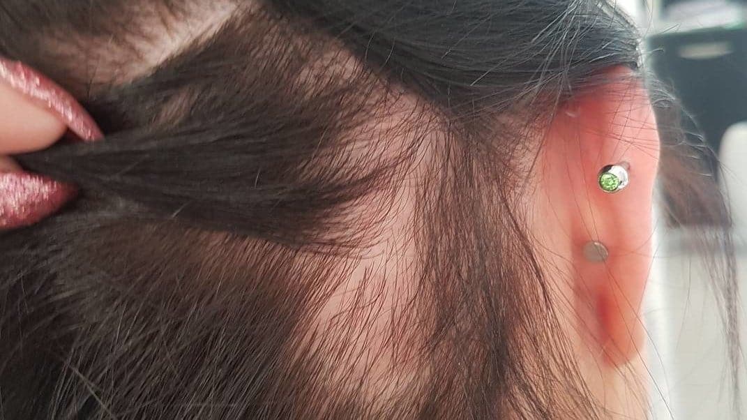 alopecia por tracao dermatologia