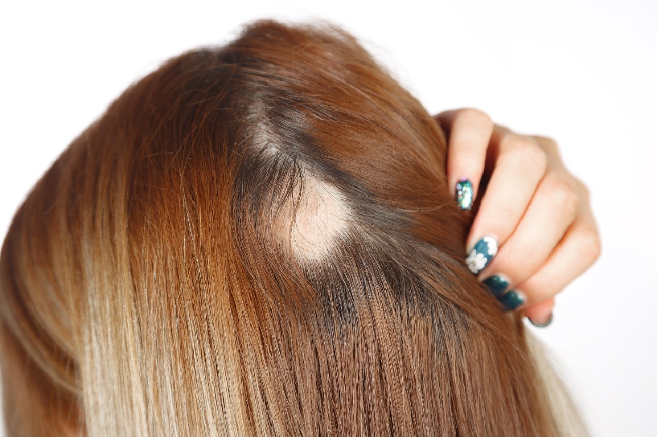 alopecia feminina 1