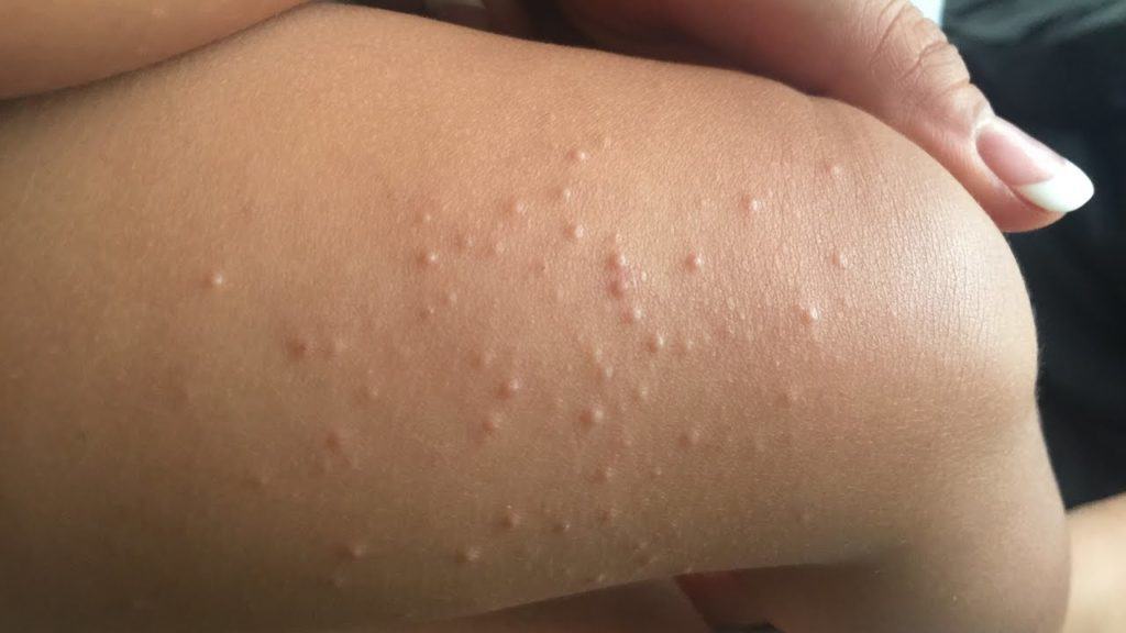 molusco contagioso o que e