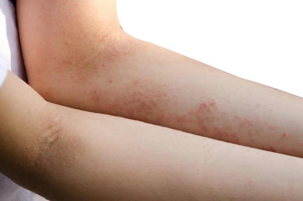dermatite-celiaca