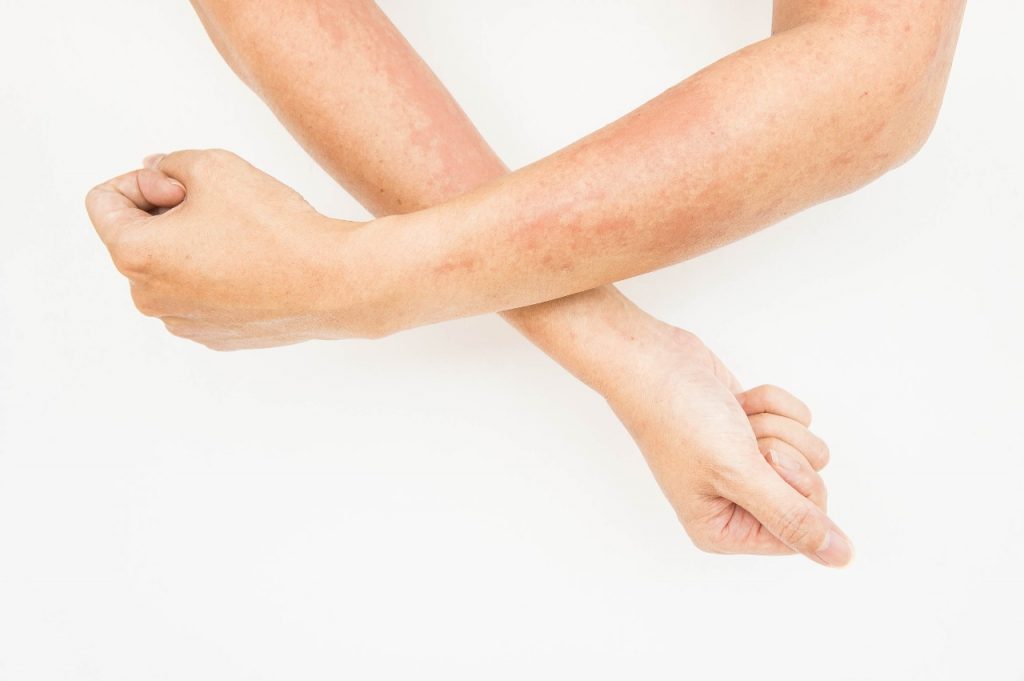 dermatite de contato