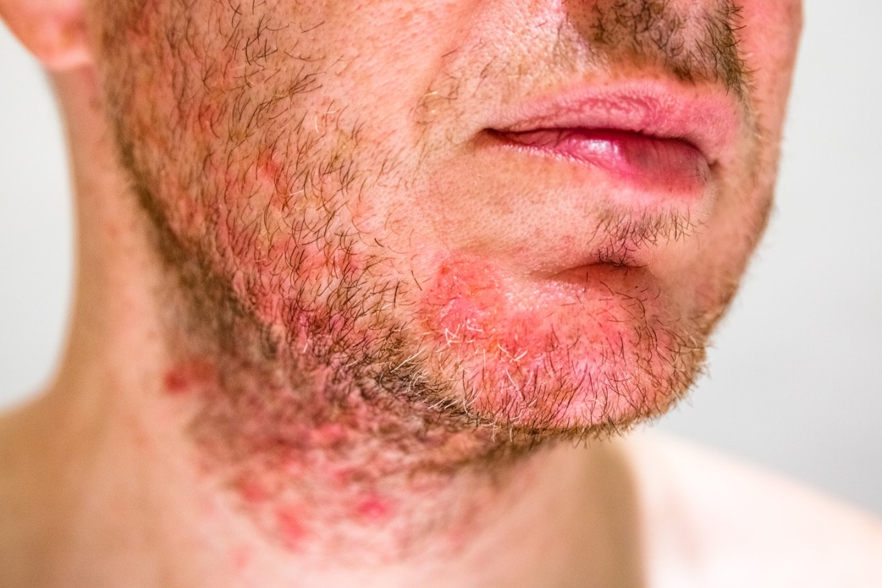 eczema 1