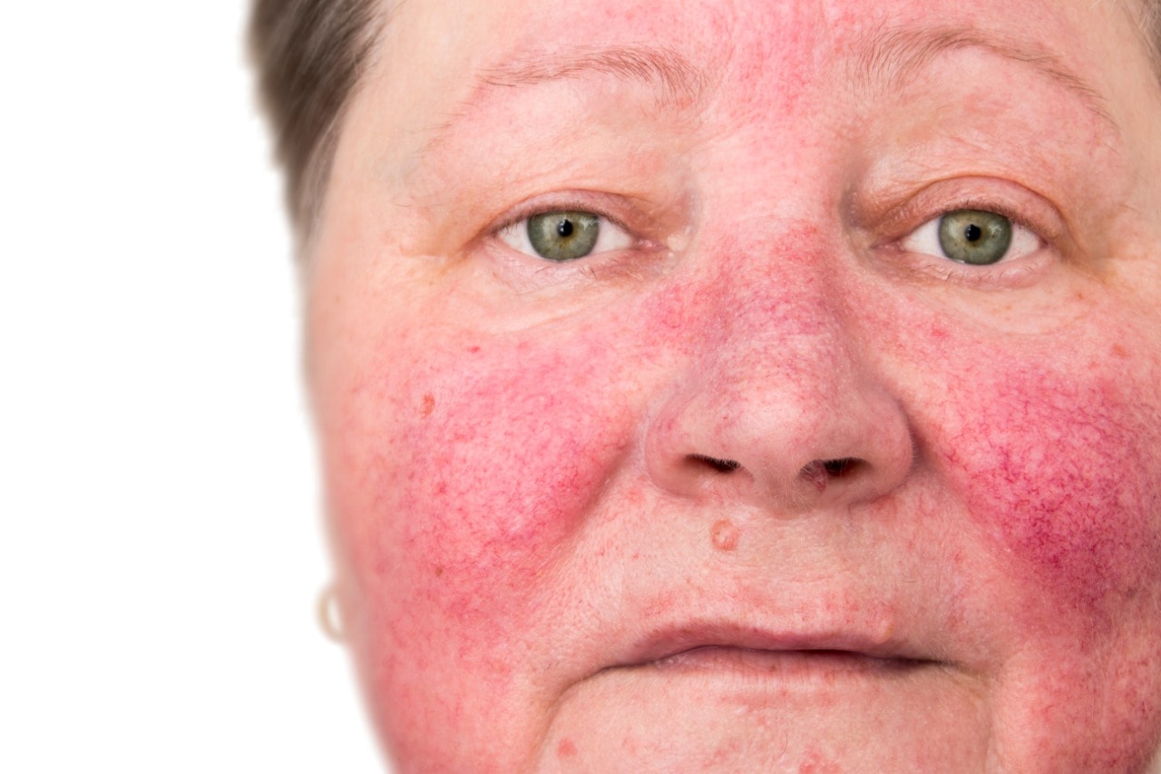 paciente com rosacea 1