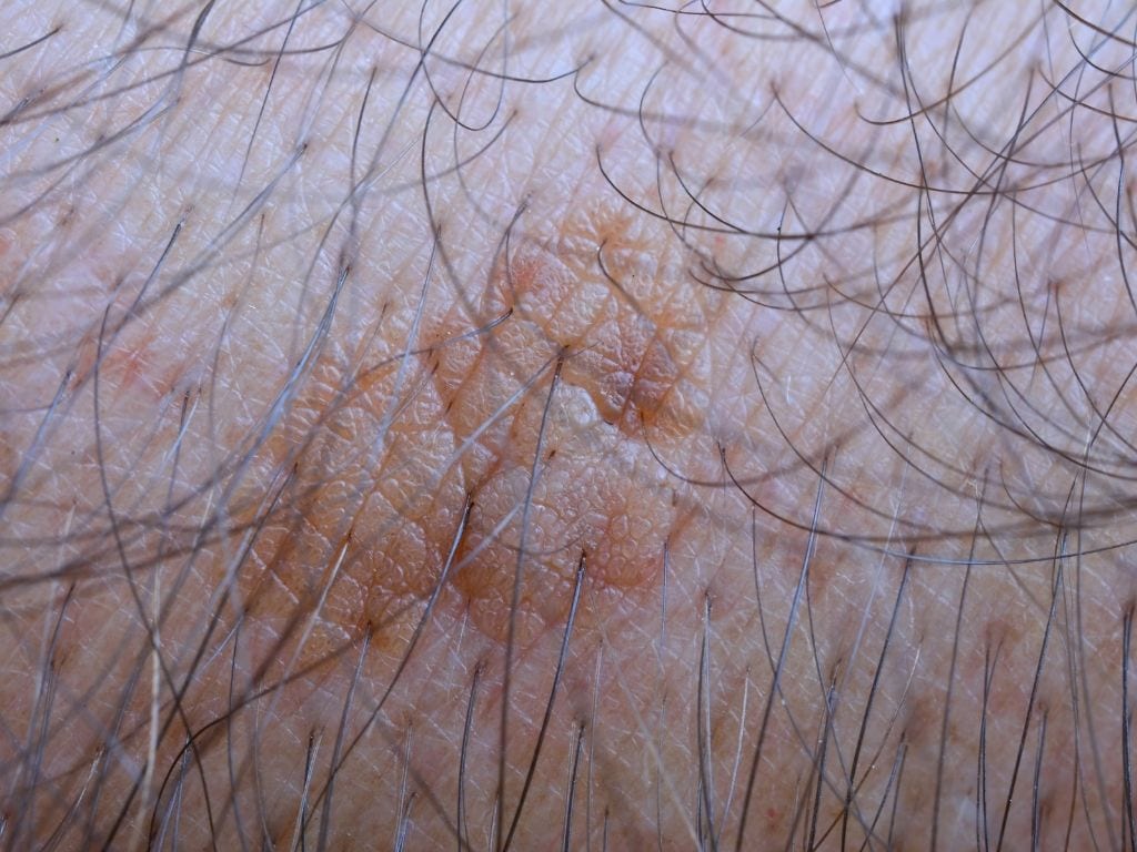 Detalhe de uma área de pele com pelos e manchas castanhas.