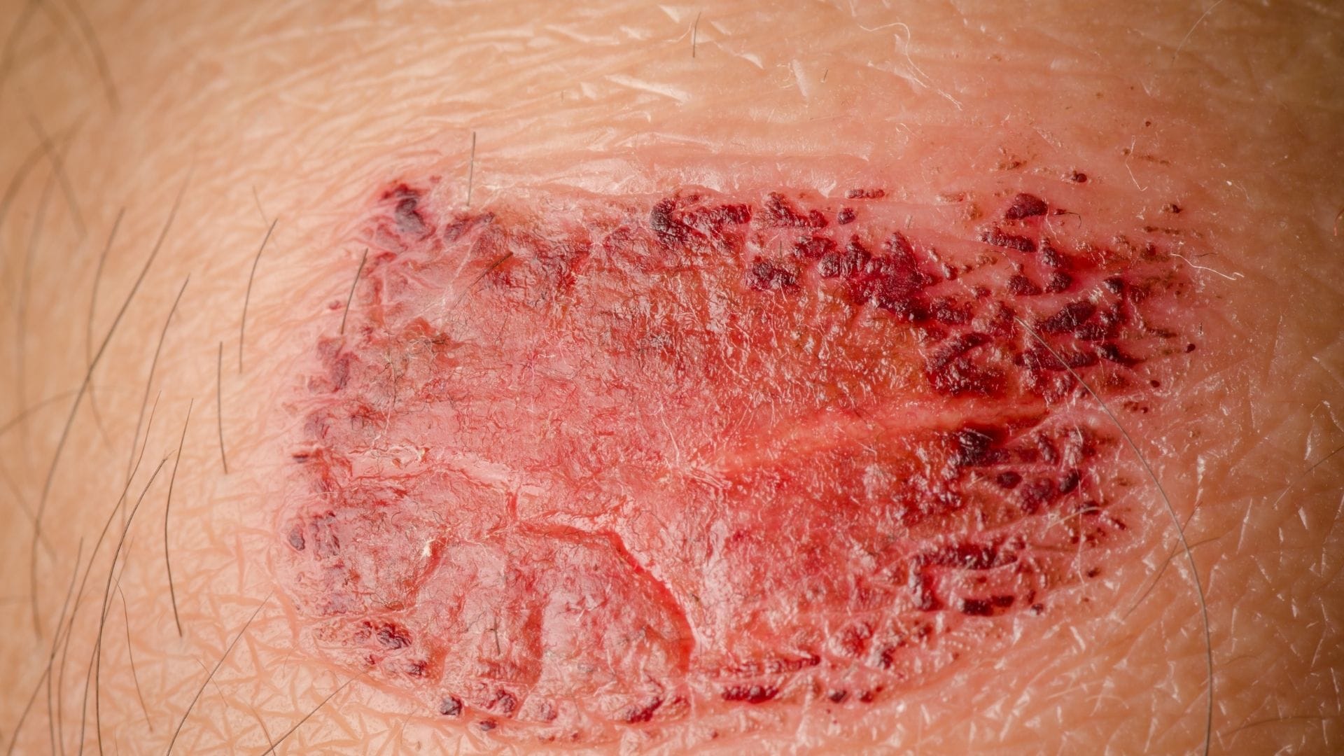 Os cânceres de pele mais comuns: carcinoma basocelular e carcinoma