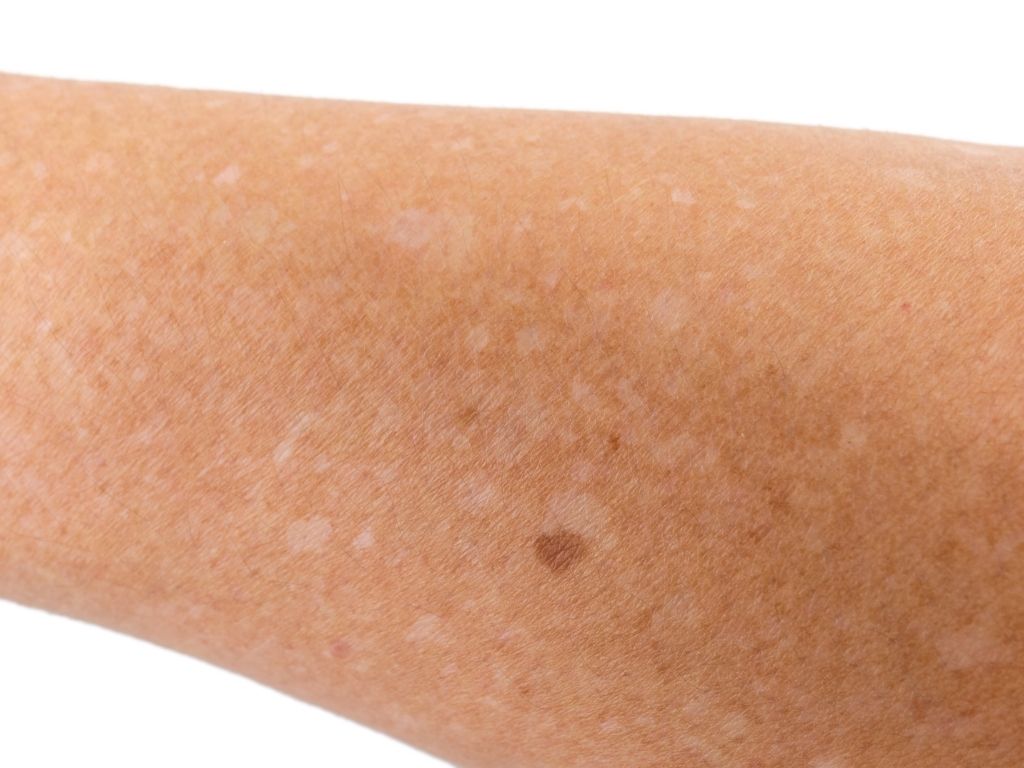 Antebraço com pequenas áreas mais claras na pele.