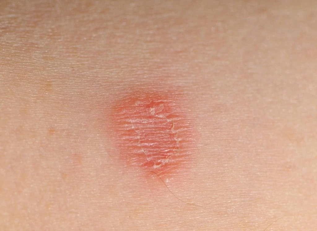 tinea corporis