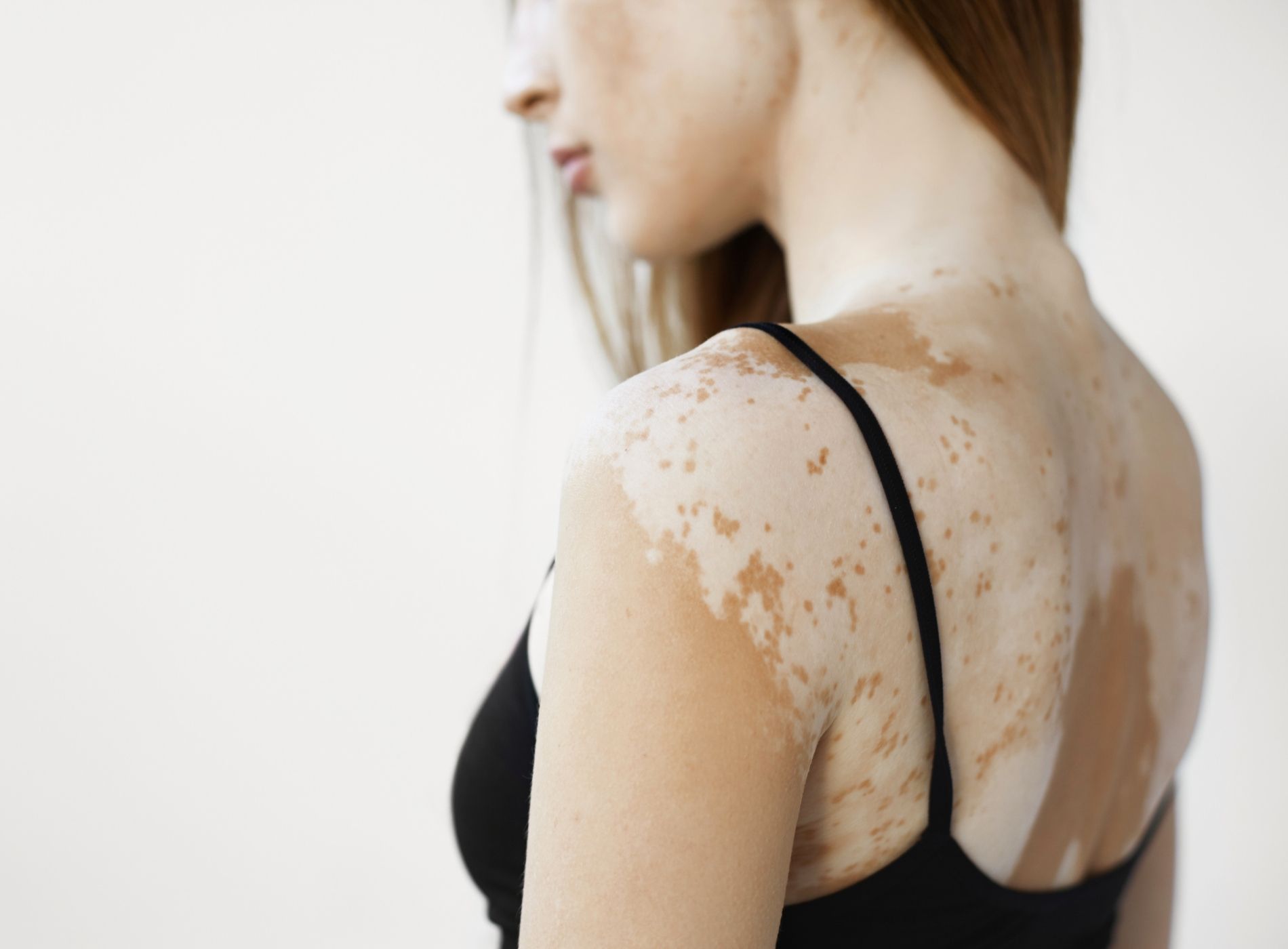 Vitiligo tem cura? Tire suas dúvidas sobre o assunto Clínica Dra