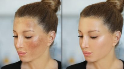 Melasma tem cura? 8 6