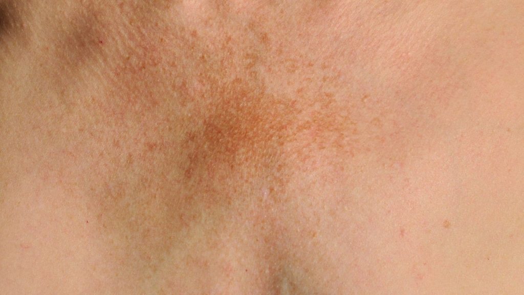 melasma no pescoço