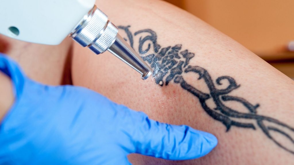 remoção de tatuagem