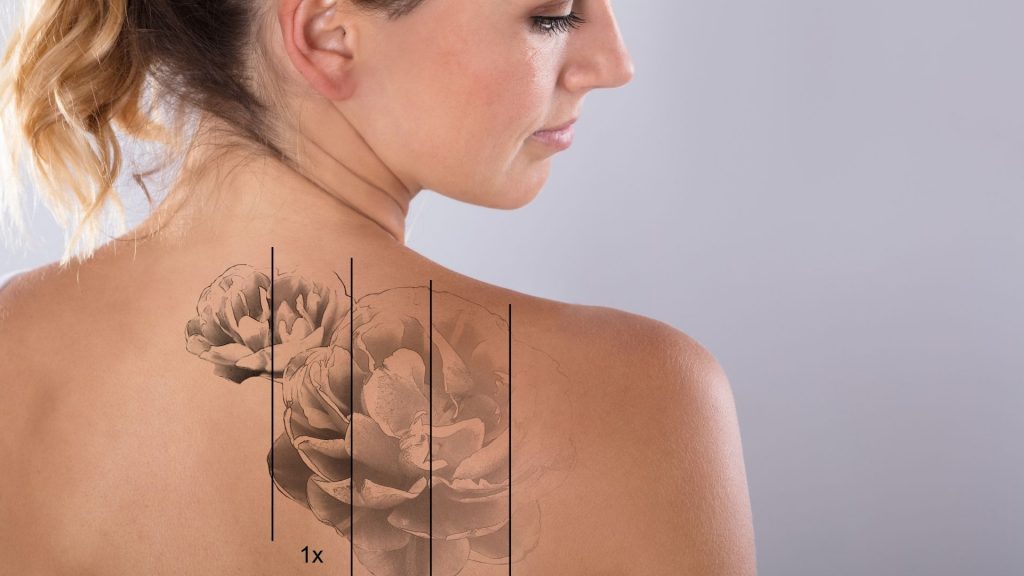 remoção de tatuagem