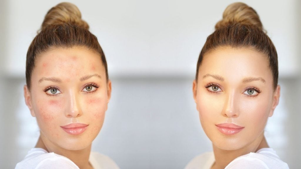 Como tratar a Acne