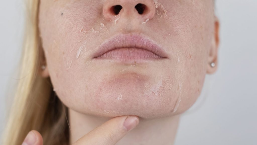 Dermatite no rosto
