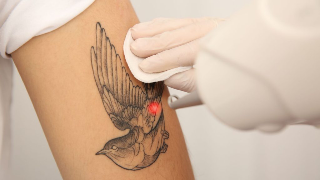 Cicatriz de remoção de tatuagem