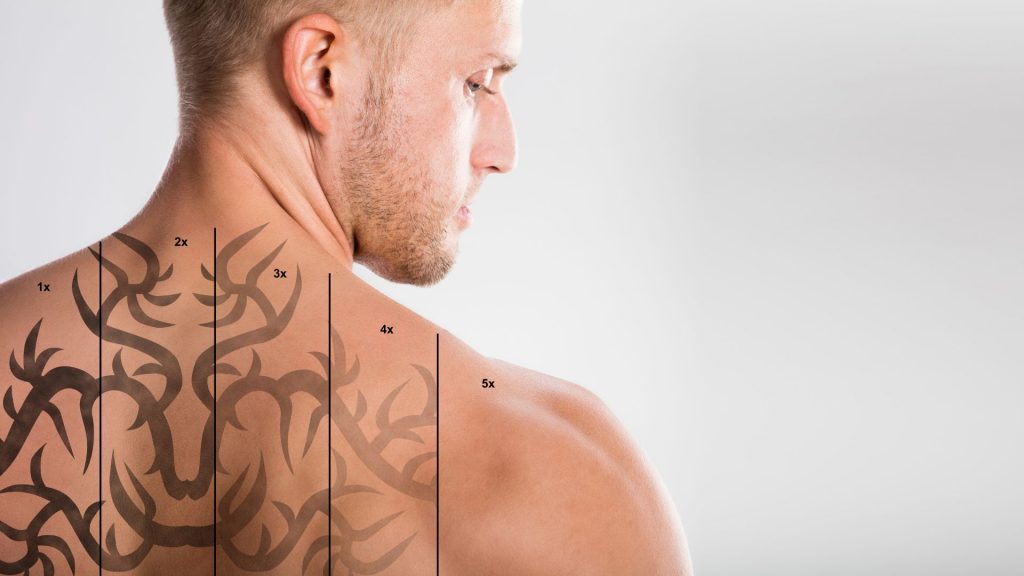 Como acelerar o processo de remoção de tatuagem