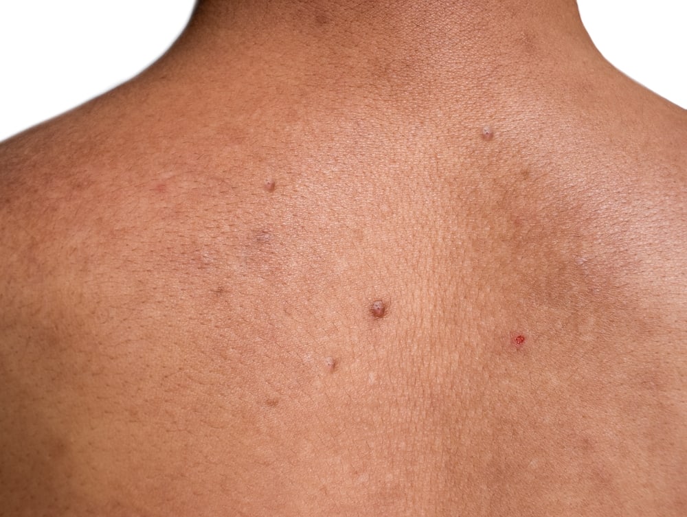 espinhas nas costas: O que fazer para melhorar
