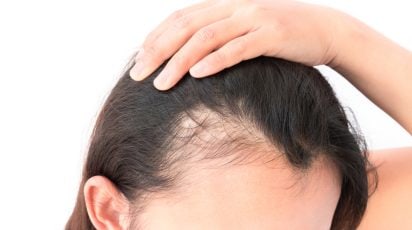 Se parar de usar Minoxidil o cabelo volta a cair?