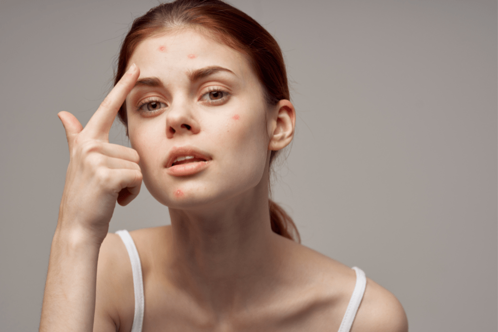 acne fúngica: saiba tudo sobre o assunto