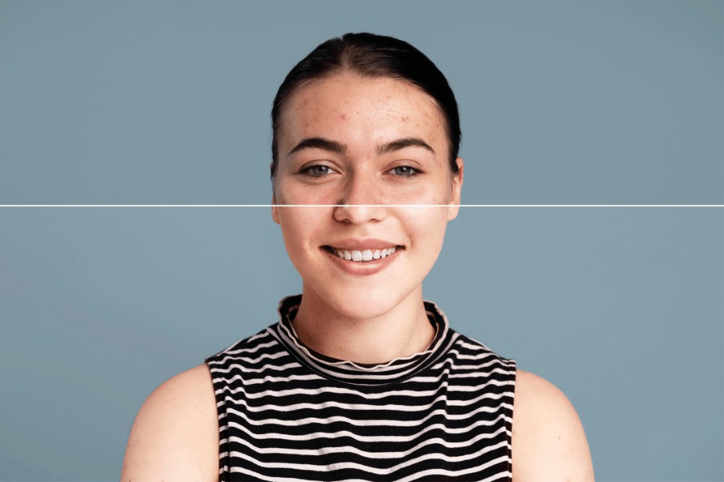 Sofre com acne? Leia o artigo e veja quais são as melhores opções de tratamento!