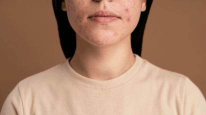 Entenda tudo sobre as manchas de acne