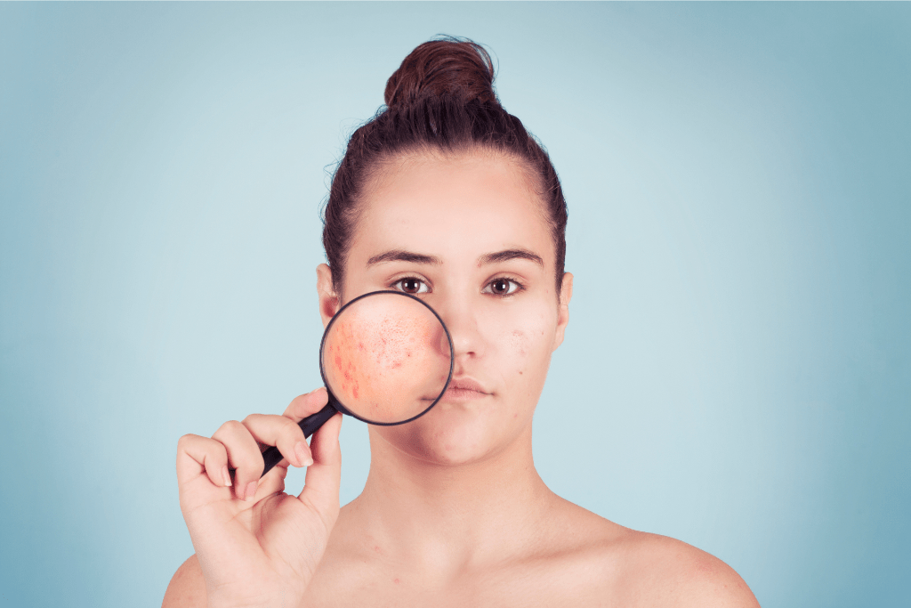 O que é acne: informações, principais causas e tipos