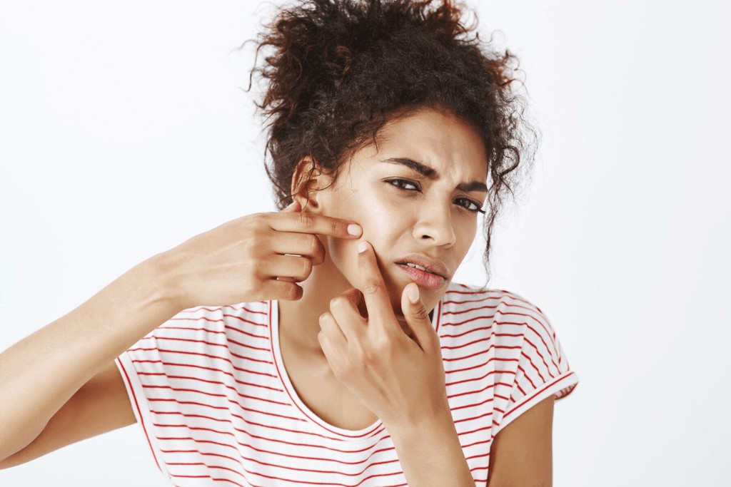 acne fúngica: o que é, causas e tratamento