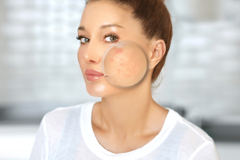 Pomada para acne: veja quais são os tipos e como usar