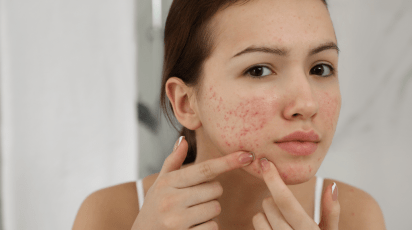 Saiba como clarear manchas de acne