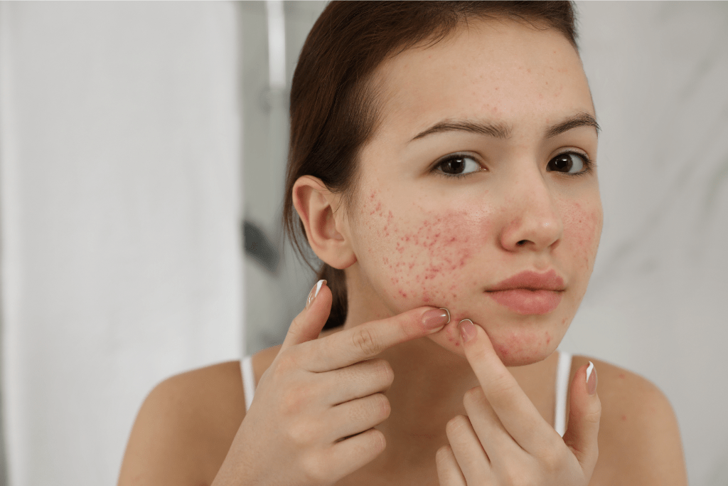 Saiba como clarear manchas de acne