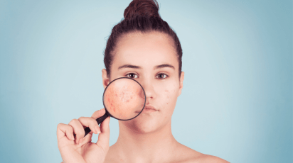 Manchas de acne: o que é e tratamento