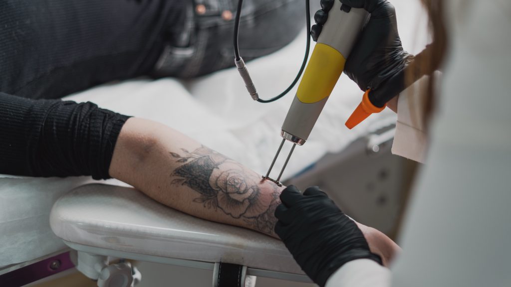 Detalhe da ponteira do laser apoiada na tatuagem do antebraço