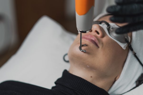 Ponteira do laser de picossegundos sobre o queixo de uma paciente com protetor ocular, em close